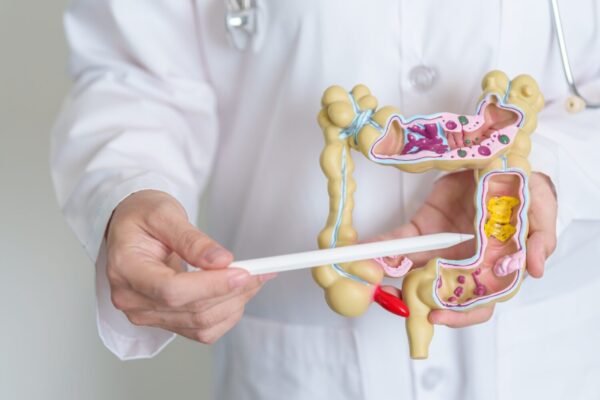 CURSOS DE COLITIS ULCERATIVA